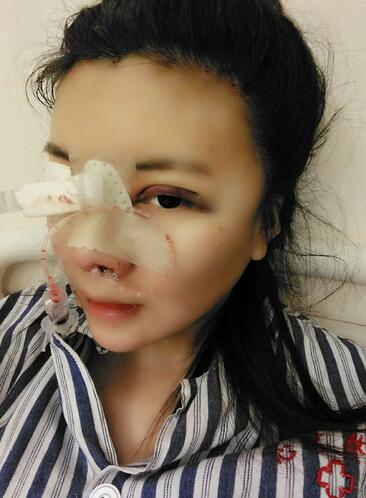 假體隆鼻兩個月后的感覺 隆鼻整形手術(shù)恢復(fù)日記