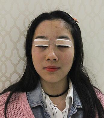開(kāi)眼角加雙眼皮15天恢復(fù)圖