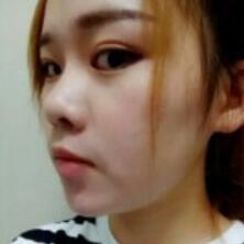 假體墊下巴一個月 前后對比