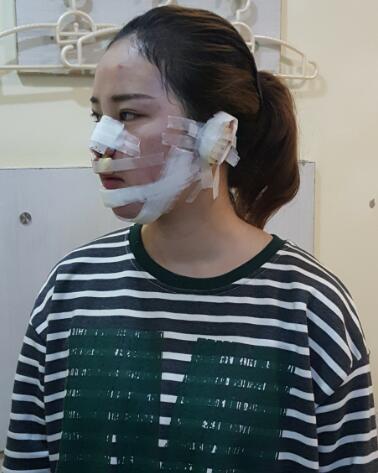 假體墊下巴一個月 前后對比