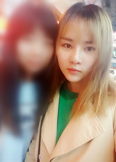 假體墊下巴一個月 前后對比