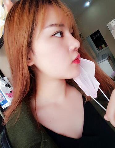 假體墊下巴一個月 前后對比