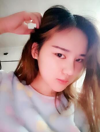 假體墊下巴一個月 前后對比