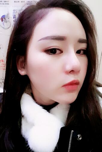 假體墊下巴一個月 前后對比