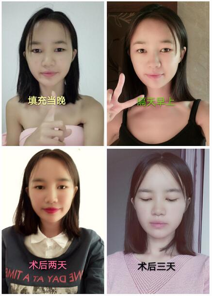 自體脂肪填充后十天圖