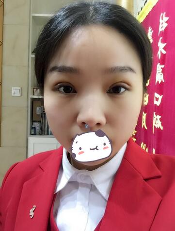 全切雙眼皮1個月過程圖