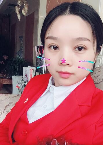 全切雙眼皮1個月過程圖