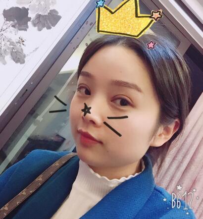 全切雙眼皮1個月過程圖