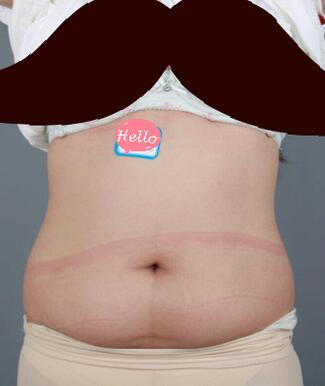 腰腹抽脂3個月的感受