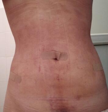 腰腹抽脂3個月的感受