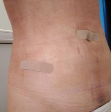 腰腹抽脂3個月的感受