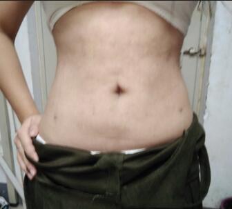 腰腹抽脂3個月的感受