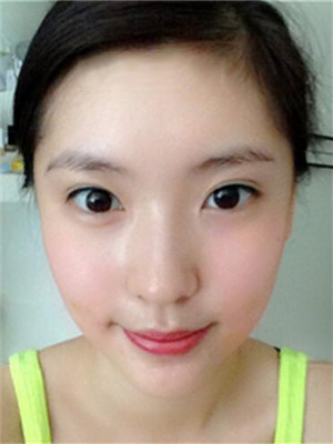 埋埋蛋白線.提升術(shù)后恢復(fù)記錄分享還有對(duì)比照