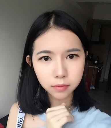 自體脂肪填充恢復(fù)日志 自體脂肪填充太陽穴+額頭