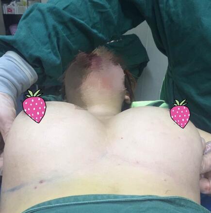 假體隆胸圓形果圖 躺下果分享