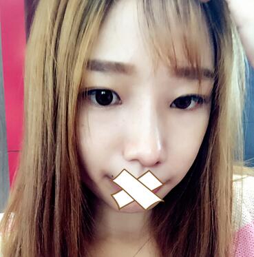 硅膠隆鼻恢復(fù)日記 硅膠隆鼻+鼻小柱延長+墊鼻尖