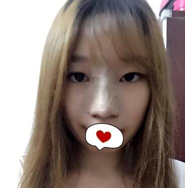 硅膠隆鼻恢復(fù)日記 硅膠隆鼻+鼻小柱延長+墊鼻尖