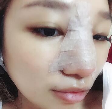 硅膠隆鼻恢復(fù)日記 硅膠隆鼻+鼻小柱延長+墊鼻尖