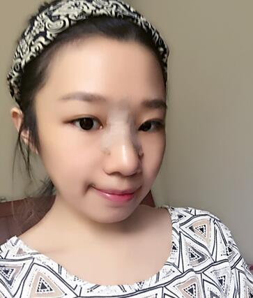 硅膠隆鼻恢復(fù)日記 硅膠隆鼻+鼻小柱延長+墊鼻尖