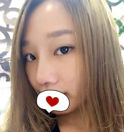 硅膠隆鼻恢復(fù)日記 硅膠隆鼻+鼻小柱延長+墊鼻尖