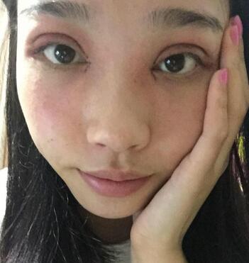 全割雙眼皮恢復(fù)日記 全切雙眼皮+開眼角