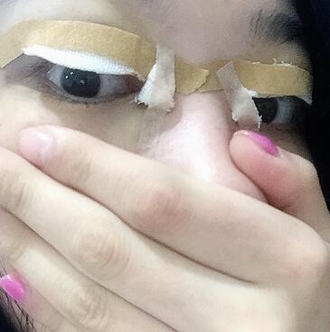 全割雙眼皮恢復(fù)日記 全切雙眼皮+開眼角