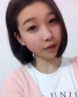 全割雙眼皮恢復(fù)日記 全切雙眼皮+開眼角