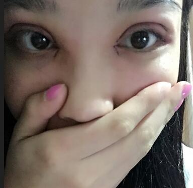 全割雙眼皮恢復(fù)日記 全切雙眼皮+開眼角