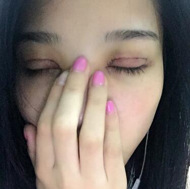 全割雙眼皮恢復(fù)日記 全切雙眼皮+開眼角