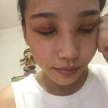 全割雙眼皮恢復(fù)日記 全切雙眼皮+開眼角