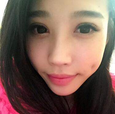 全割雙眼皮恢復(fù)日記 全切雙眼皮+開眼角