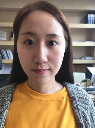 面部脂肪填充后圖片 自體脂肪面部填充恢復(fù)記錄