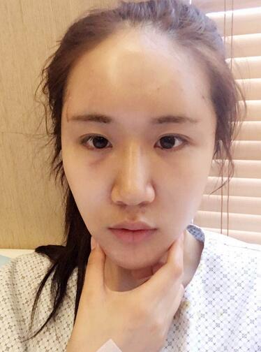 面部脂肪填充后圖片 自體脂肪面部填充恢復(fù)記錄