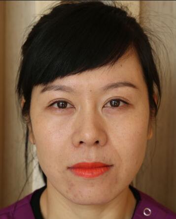 面部埋埋蛋白線.提升恢復(fù)過(guò)程分享