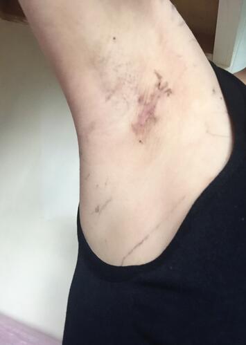 假體隆胸術(shù)后恢復(fù)3個(gè)月紀(jì)實(shí)