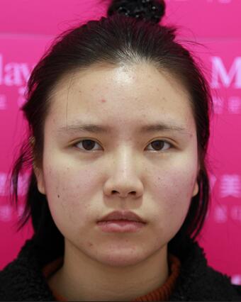 耳軟骨墊鼻尖一個月圖