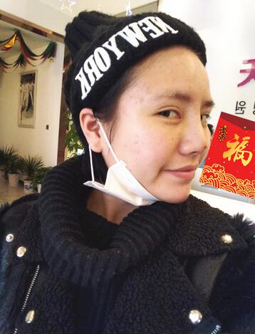 耳軟骨墊鼻尖一個月圖