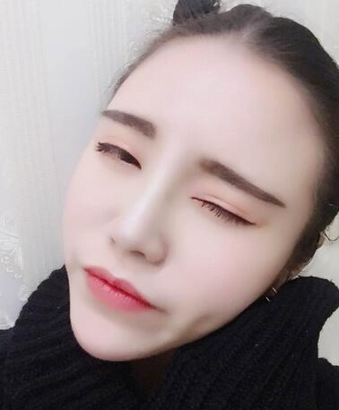 耳軟骨墊鼻尖一個月圖