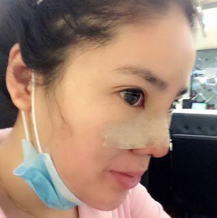 隆鼻整形2個(gè)月恢復(fù)日記 硅膠隆鼻+鼻翼縮小