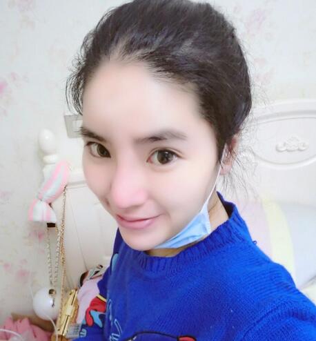 隆鼻整形2個(gè)月恢復(fù)日記 硅膠隆鼻+鼻翼縮小