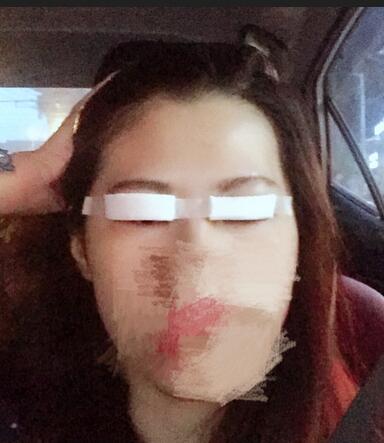 切開重瞼術(shù)恢復過程圖