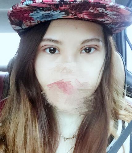 切開重瞼術(shù)恢復過程圖