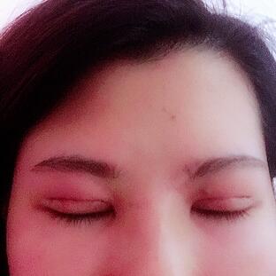 切開重瞼術(shù)恢復過程圖