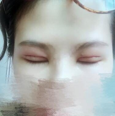 切開重瞼術(shù)恢復過程圖