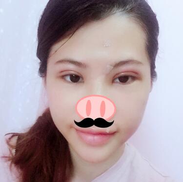 切開重瞼術(shù)恢復過程圖