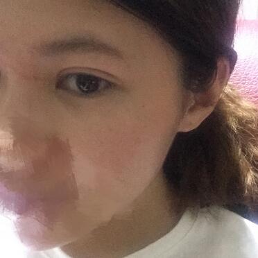 切開重瞼術(shù)恢復過程圖