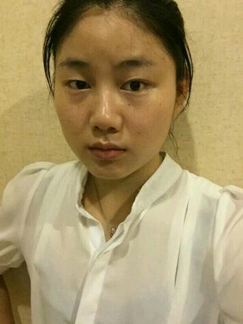 全切雙眼皮半年恢復(fù)過程圖