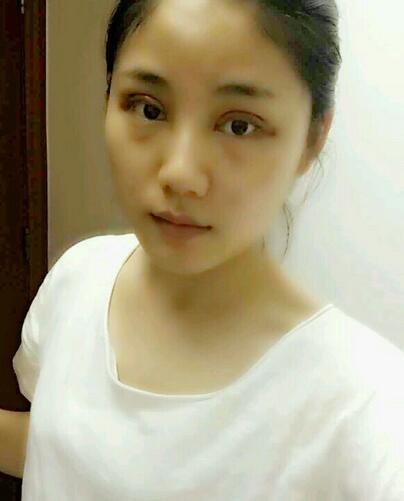 全切雙眼皮半年恢復(fù)過程圖