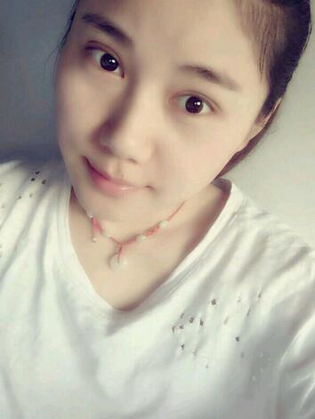 全切雙眼皮半年恢復(fù)過程圖