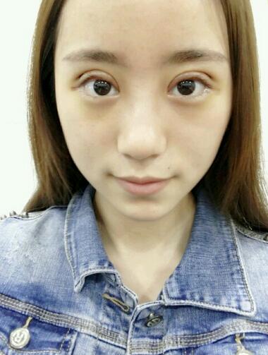 割雙眼皮案例圖片 雙眼皮手術(shù)20天